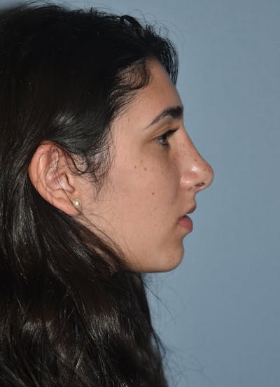Rhinoplasty Before & After Gallery - Patient 32577020 - Image 2