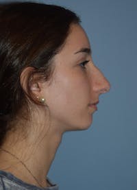 Rhinoplasty Before & After Gallery - Patient 32577119 - Image 1