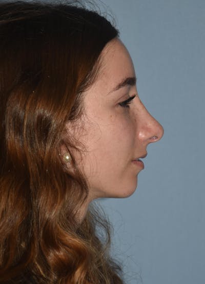 Rhinoplasty Before & After Gallery - Patient 32577119 - Image 2