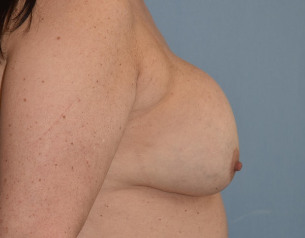 Breast Revision Before & After Gallery - Patient 34853592 - Image 3