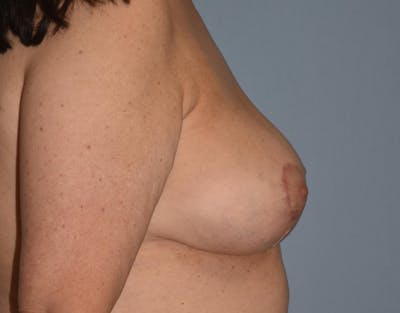 Breast Revision Before & After Gallery - Patient 34853592 - Image 4