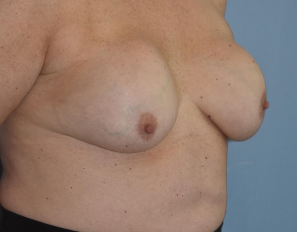 Breast Revision Before & After Gallery - Patient 34853592 - Image 5