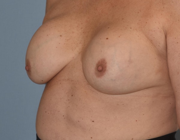 Breast Revision Before & After Gallery - Patient 34853592 - Image 9
