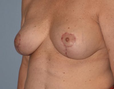 Breast Revision Before & After Gallery - Patient 34853592 - Image 10