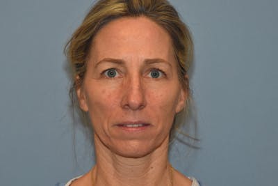 Facelift Before & After Gallery - Patient 40631689 - Image 1