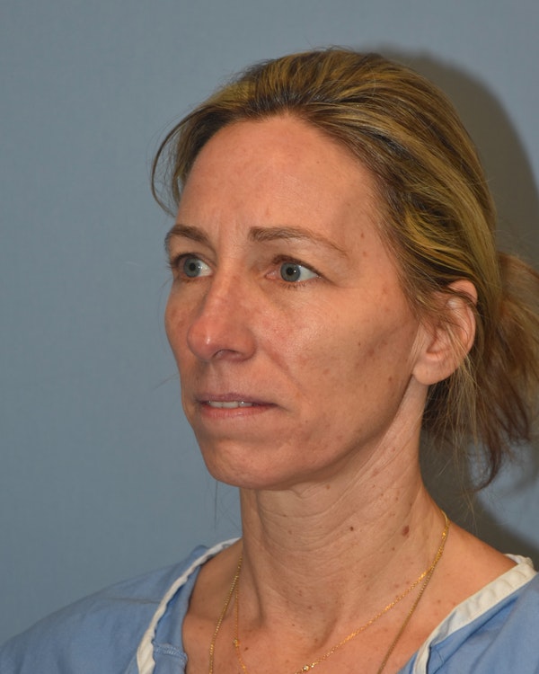 Facelift Before & After Gallery - Patient 40631689 - Image 3