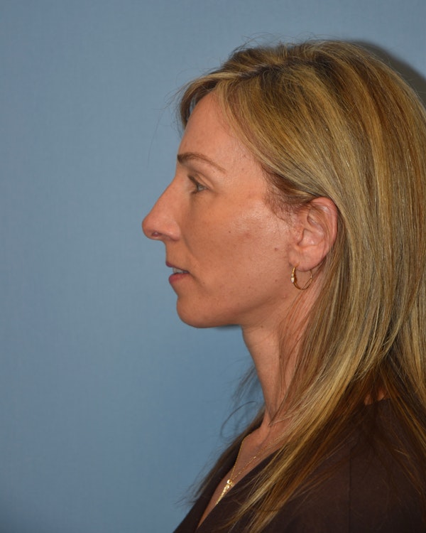 Facelift Before & After Gallery - Patient 40631689 - Image 6