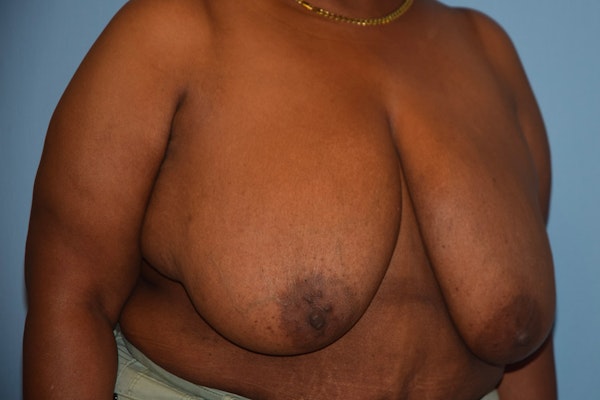 Breast Reduction Before & After Gallery - Patient 92168024 - Image 3