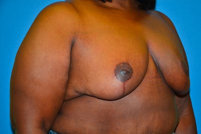 Breast Reduction Before & After Gallery - Patient 92168024 - Image 4