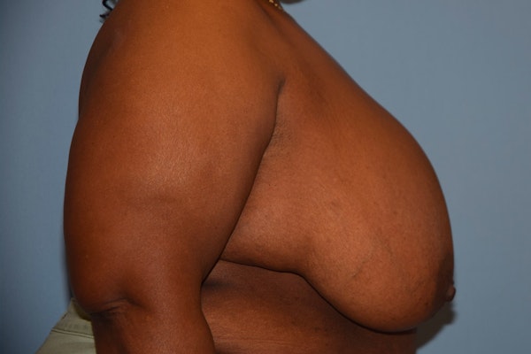 Breast Reduction Before & After Gallery - Patient 92168024 - Image 5