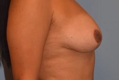 Breast Lift Before & After Gallery - Patient 92168028 - Image 6