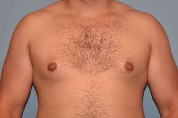 Gynecomastia Before & After Gallery - Patient 92166627 - Image 1
