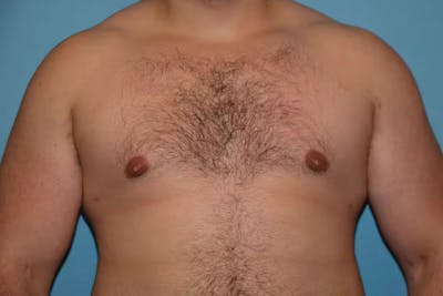 Gynecomastia Before & After Gallery - Patient 92166627 - Image 2