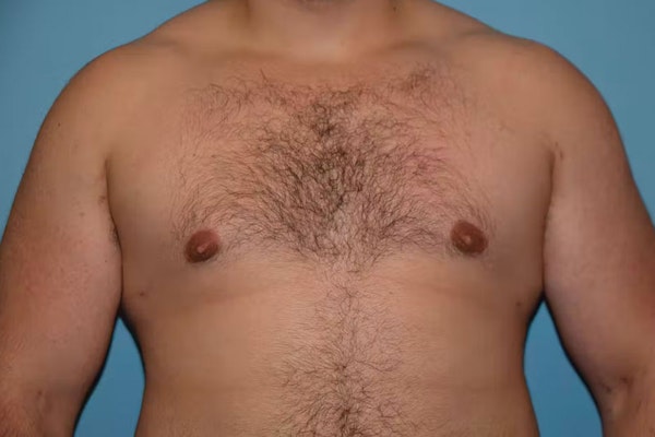 Gynecomastia Before & After Gallery - Patient 92166627 - Image 2