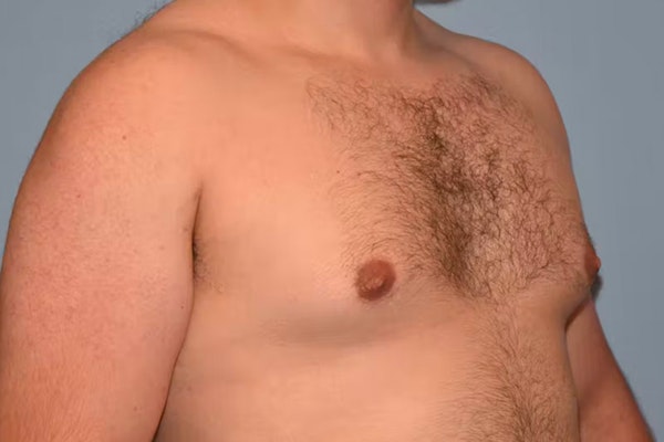 Gynecomastia Before & After Gallery - Patient 92166627 - Image 3