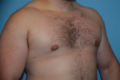 Gynecomastia Before & After Gallery - Patient 92166627 - Image 4