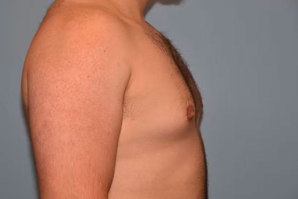 Gynecomastia Before & After Gallery - Patient 92166627 - Image 5