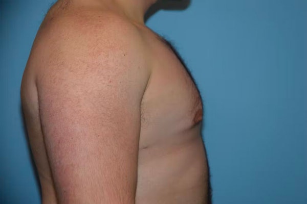 Gynecomastia Before & After Gallery - Patient 92166627 - Image 6