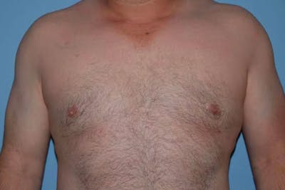 Gynecomastia Before & After Gallery - Patient 6389435 - Image 2
