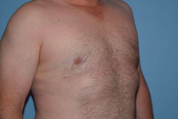Gynecomastia Before & After Gallery - Patient 6389435 - Image 4