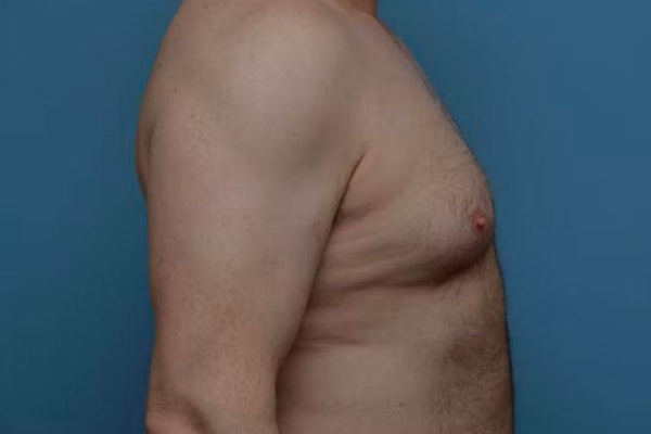 Gynecomastia Before & After Gallery - Patient 6389435 - Image 5