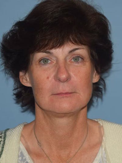 Facelift Before & After Gallery - Patient 92151507 - Image 2