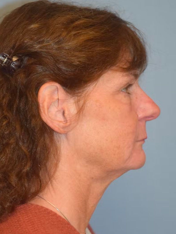 Facelift Before & After Gallery - Patient 92151507 - Image 5