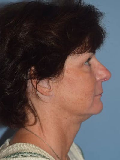 Facelift Before & After Gallery - Patient 92151507 - Image 6