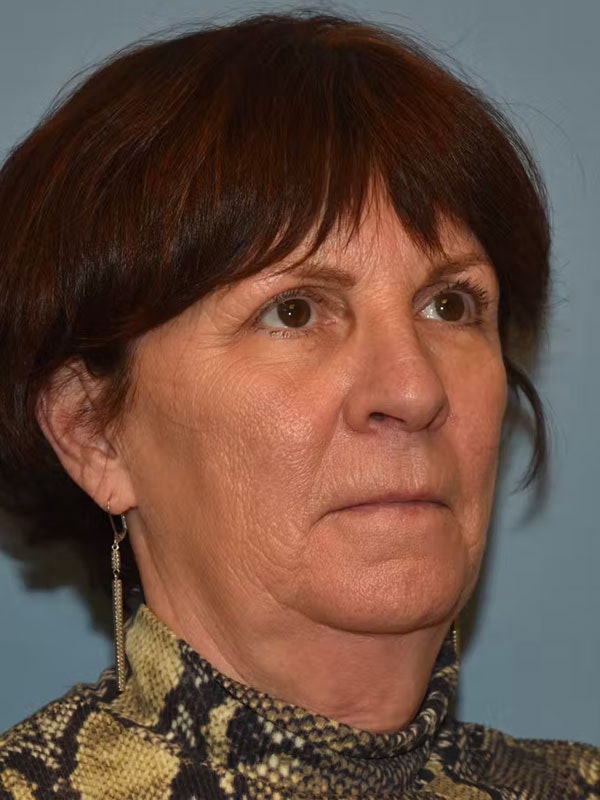 Facelift Before & After Gallery - Patient 96909320 - Image 3