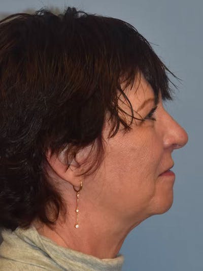 Facelift Before & After Gallery - Patient 96909320 - Image 6