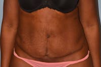 Tummy Tuck Before & After Gallery - Patient 96421374 - Image 1