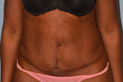 Tummy Tuck Gallery - Patient 96421374 - Image 1