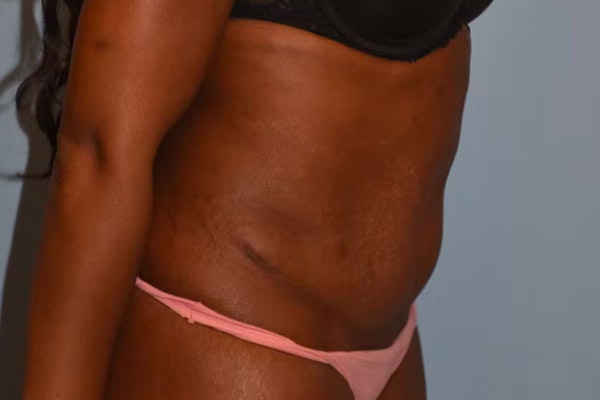 Tummy Tuck Before & After Gallery - Patient 96421374 - Image 5