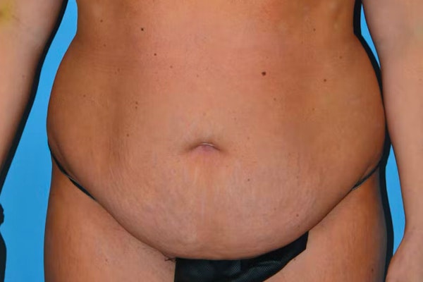 Tummy Tuck Before & After Gallery - Patient 40633077 - Image 1