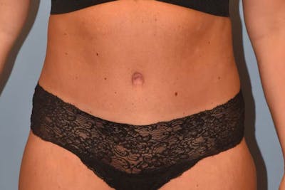Tummy Tuck Before & After Gallery - Patient 40633077 - Image 2