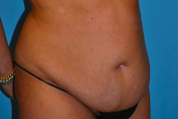 Tummy Tuck Gallery - Patient 40633077 - Image 3
