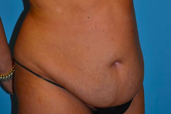 Tummy Tuck Before & After Gallery - Patient 40633077 - Image 3