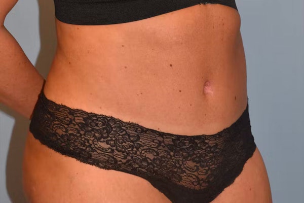 Tummy Tuck Before & After Gallery - Patient 40633077 - Image 4