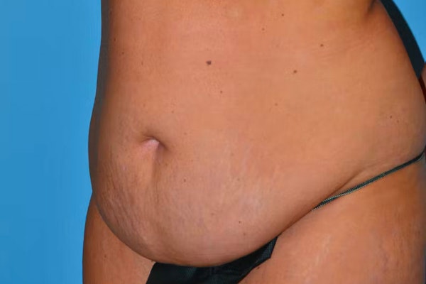 Tummy Tuck Before & After Gallery - Patient 40633077 - Image 5