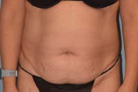 Tummy Tuck Before & After Gallery - Patient 26333163 - Image 1