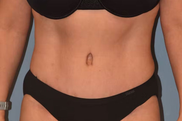 Tummy Tuck Before & After Gallery - Patient 26333163 - Image 2
