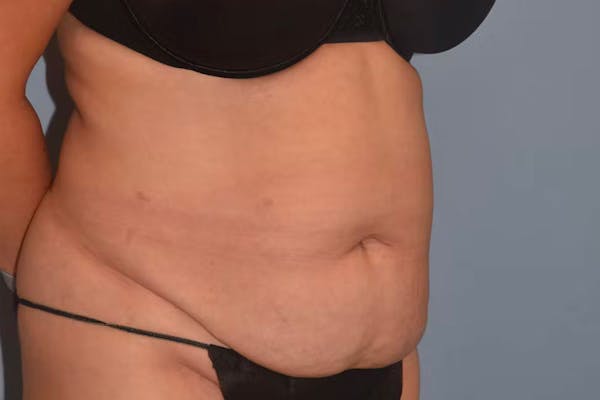 Tummy Tuck Before & After Gallery - Patient 26333163 - Image 3