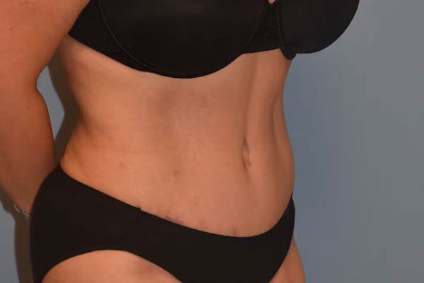 Tummy Tuck Before & After Gallery - Patient 26333163 - Image 4