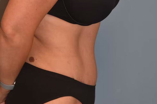 Tummy Tuck Before & After Gallery - Patient 26333163 - Image 6