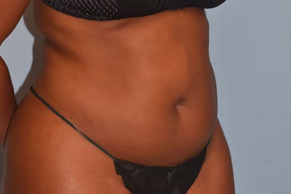 Liposuction Before & After Gallery - Patient 40624101 - Image 3