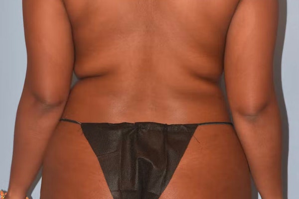 Liposuction Before & After Gallery - Patient 40624101 - Image 7