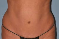 Liposuction Before & After Gallery - Patient 16555409 - Image 1