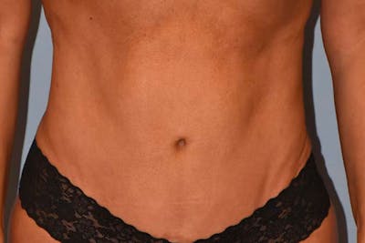Liposuction Before & After Gallery - Patient 16555409 - Image 2