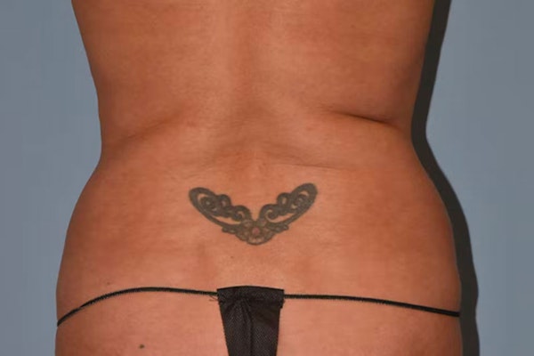 Liposuction Before & After Gallery - Patient 16555409 - Image 5