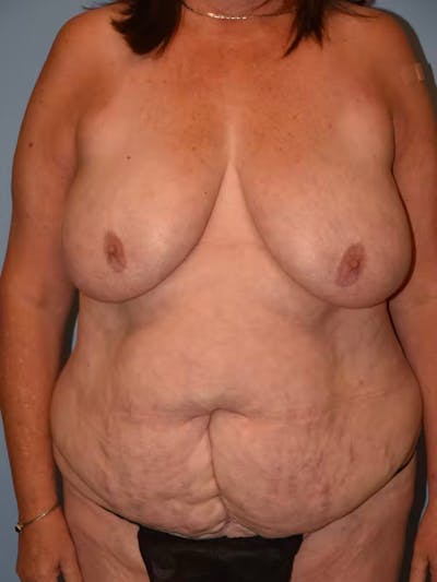 Mommy Makeover Gallery - Patient 92167436 - Image 1